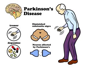 Parkinson_s disease
